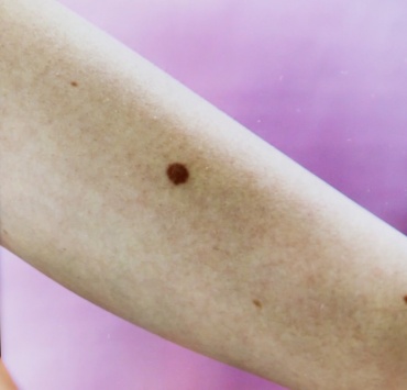 Dezembro Laranja: campanha conscientiza sobre a prevenção ao câncer de pele